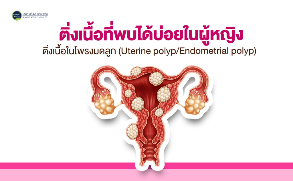 Common Polyps Found in Women ติ่งเนื้อที่พบได้บ่อยในผู้หญิง