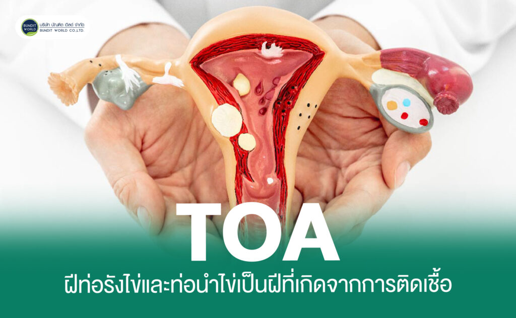 Tubo-Ovarian Abscess(TOA) ฝีท่อรังไข่และท่อนำไข่เป็นฝีที่เกิดจากการติดเชื้อ