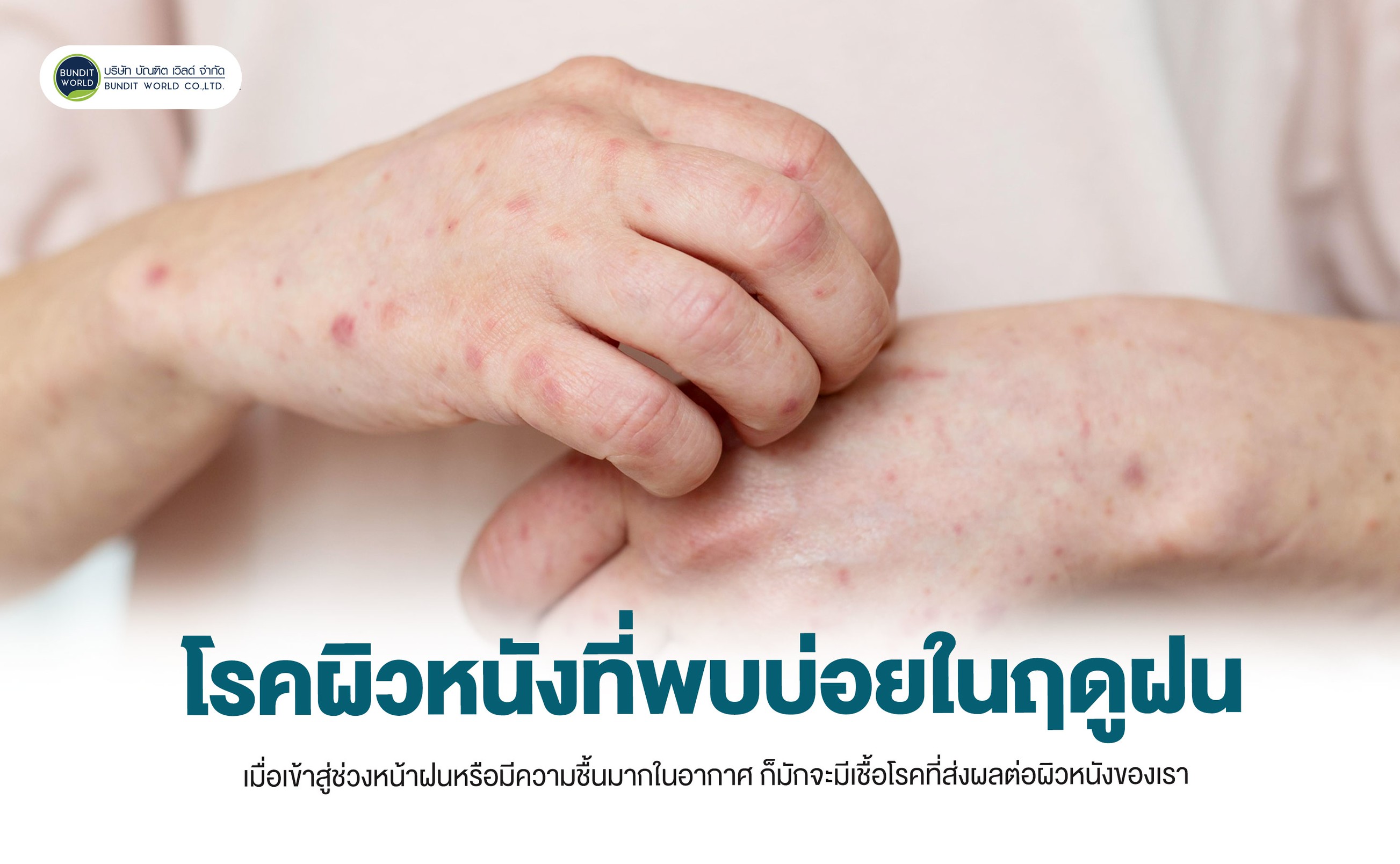 Common skin diseases during the rainy season โรคผิวหนังที่พบบ่อยในฤดูฝน