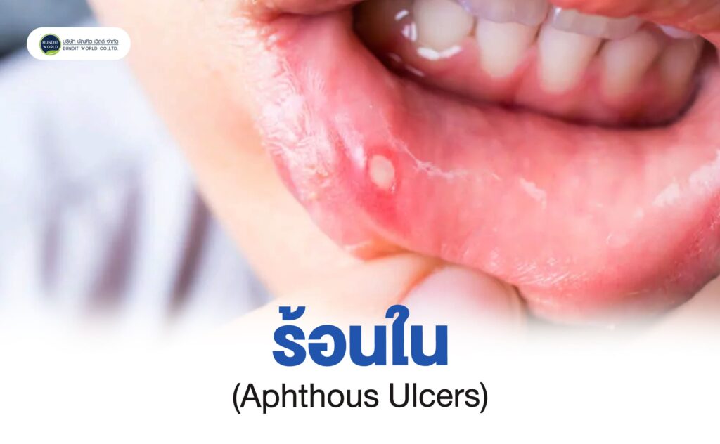Aphthous Ulcers ร้อนใน
