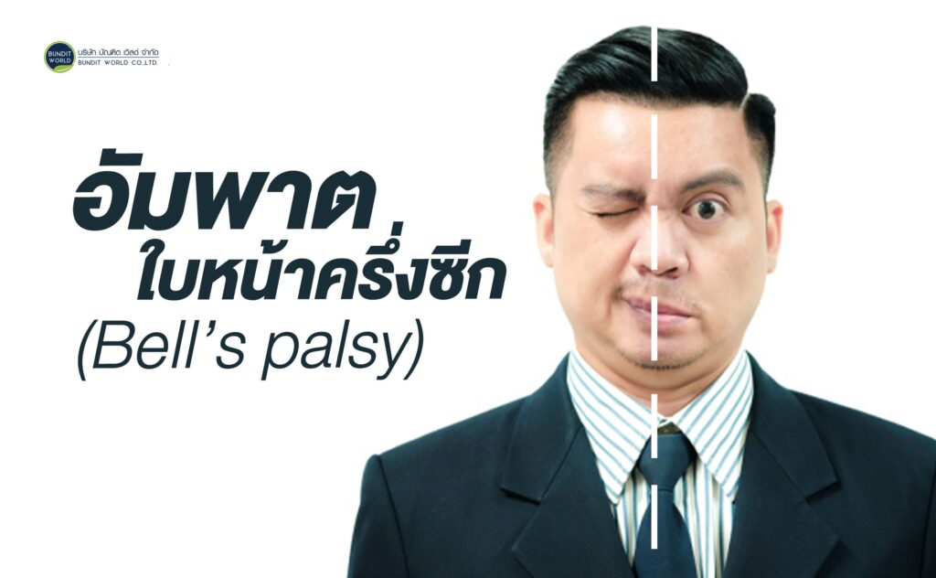 Bell palsy อัมพาตใบหน้าครึ่งซีก