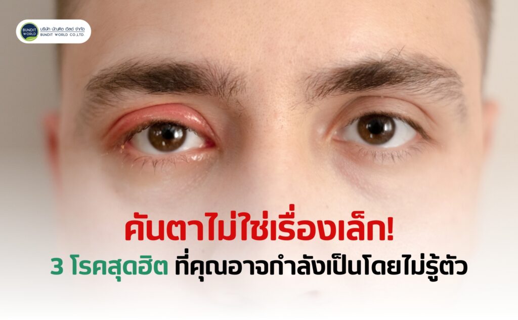 Eye