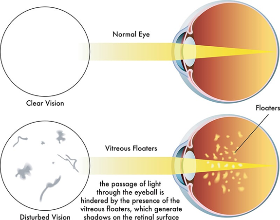 Vitreous Degeneration
