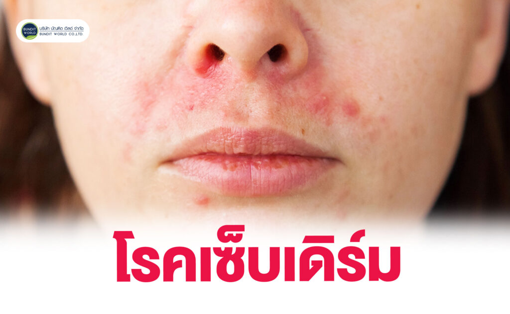 Seborrheic Dermatitis