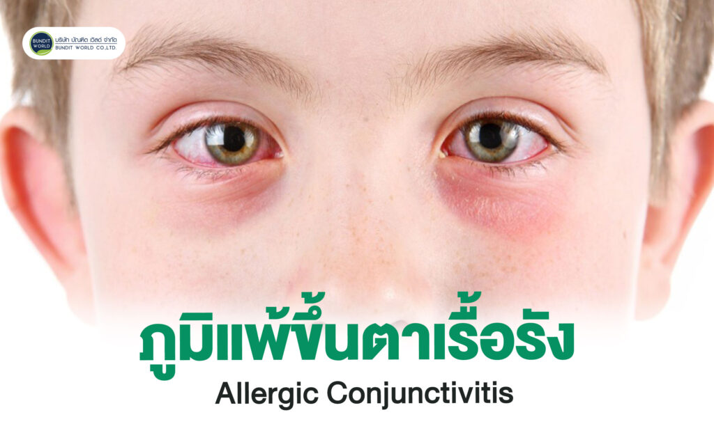 Allergic Conjunctivitis