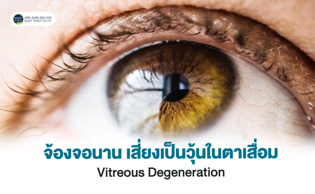 Vitreous Degeneration