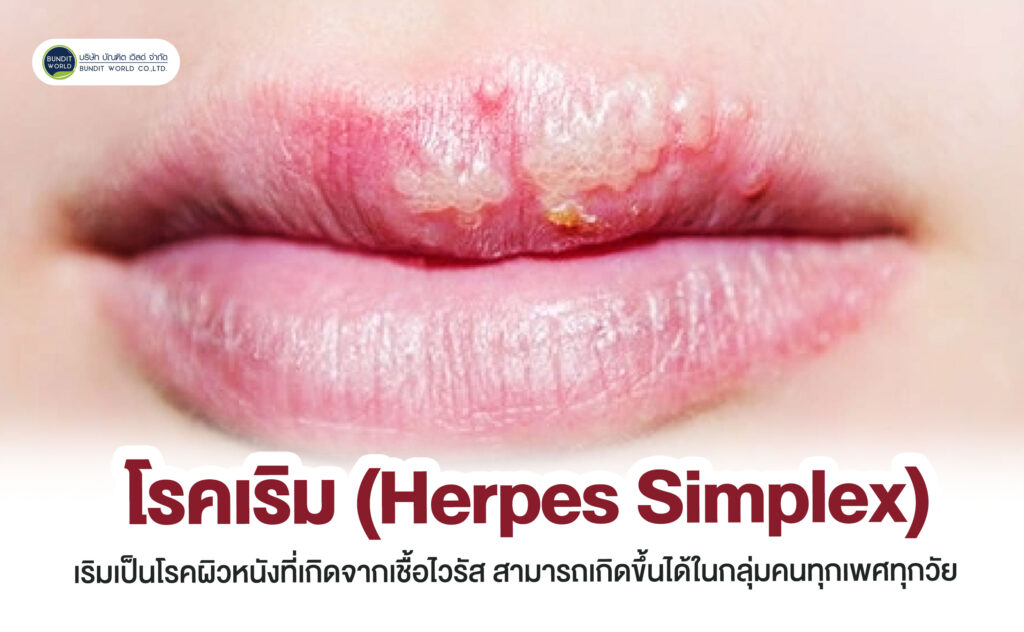 Herpes Simplex