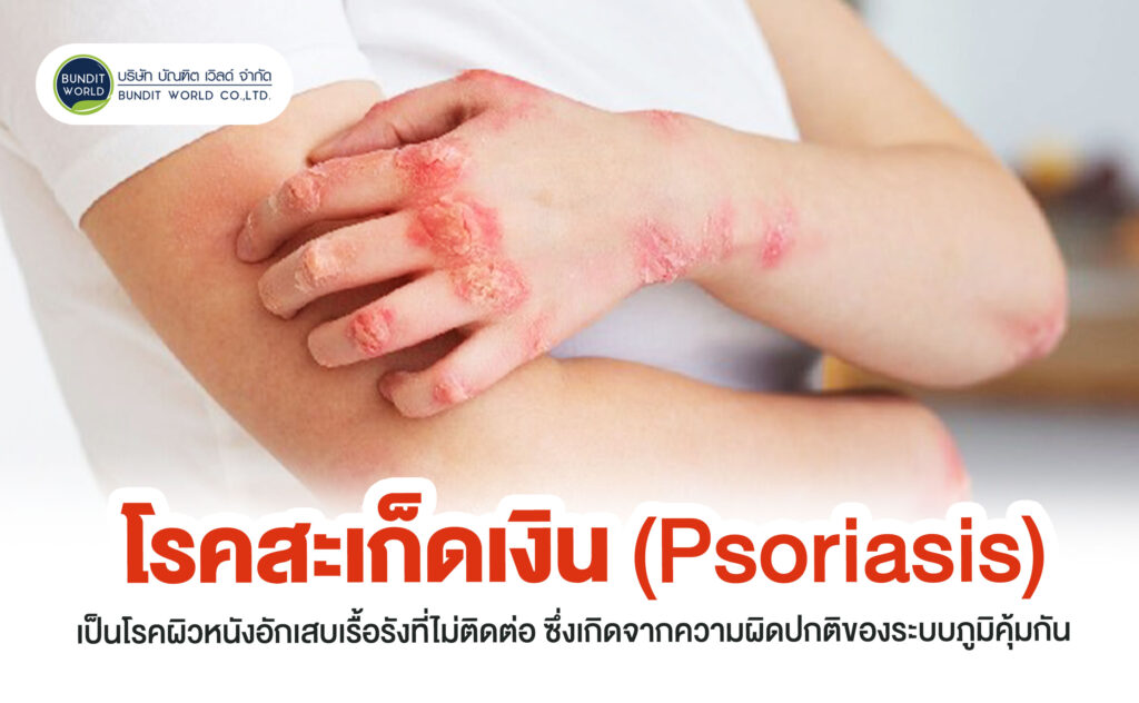Psoriasis