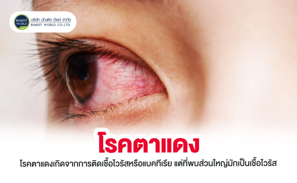 Conjunctivitis