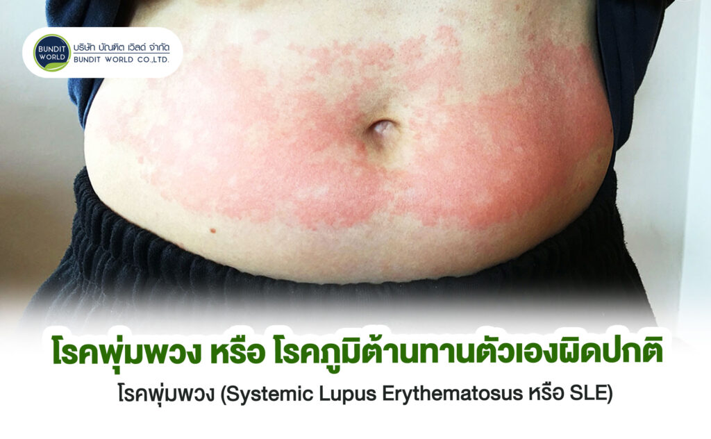 Systemic Lupus Erythematosus