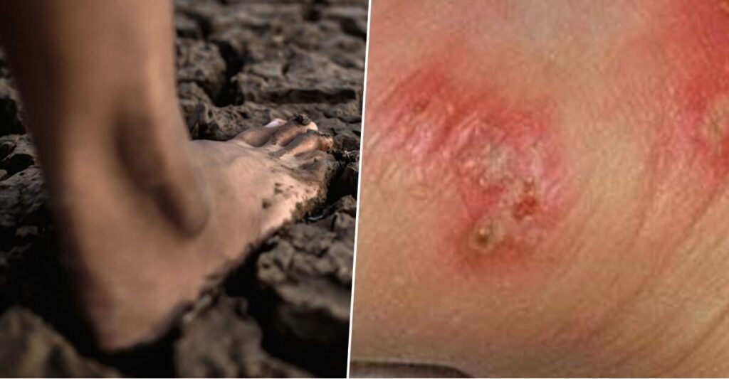 MELIOIDOSIS โรคเมลิออยโดสิส